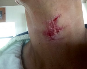 My Sore Throat After Phototherapy