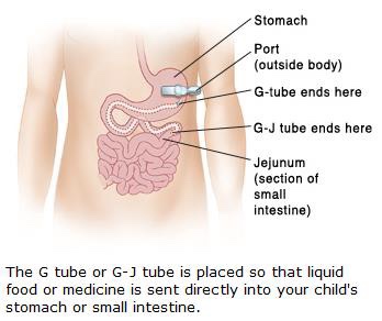 Leaking gastrostomy tube – smile each and every day